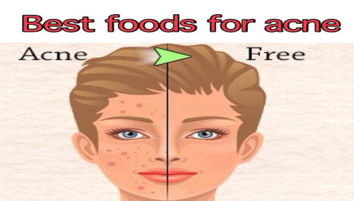 Best Foods For Acne