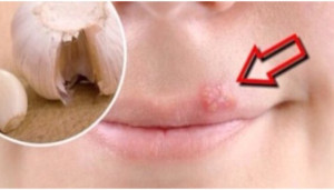 How to Prevent Cold Sores