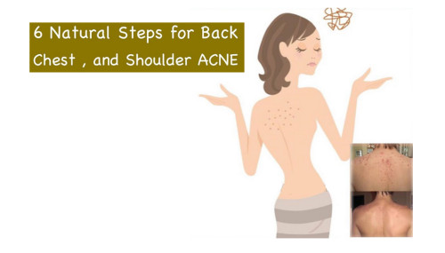 6 Natural Steps For Back, Chest and Shoulder ACNE